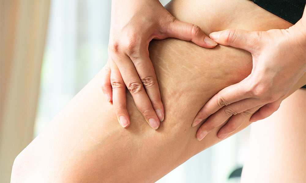 How to Get Rid of Cellulite on Thighs and Bum