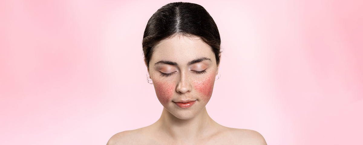 Does retinol treat rosacea or make it worse? – Maryann Organics